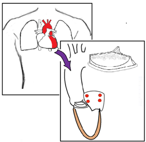 Patient FAQs - Stent Triple Therapy